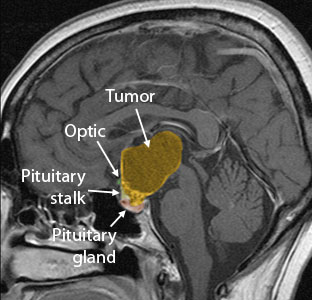 Increase In Awareness Of  Craniopharyngioma Needed