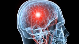 Studies Uncover Long-term Effects Of Traumatic Brain Injury